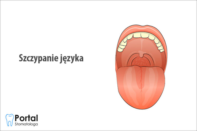 Szczypanie języka