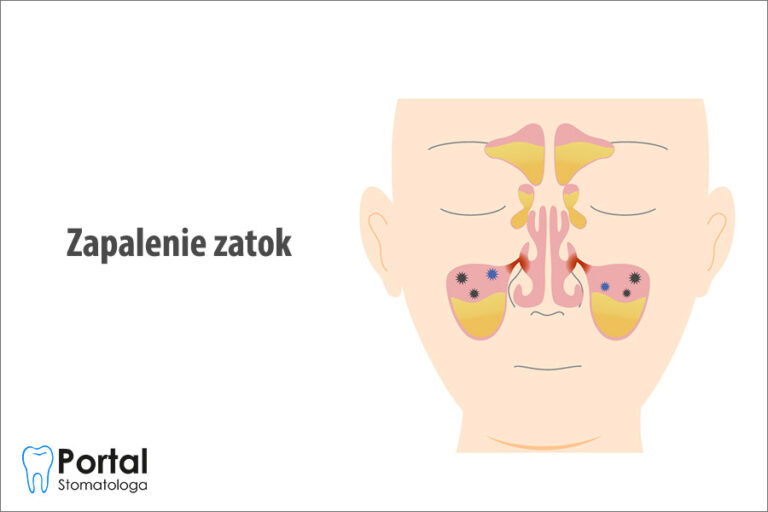 Zapalenie zatok