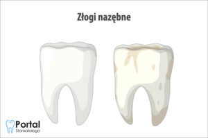 Złogi nazębne