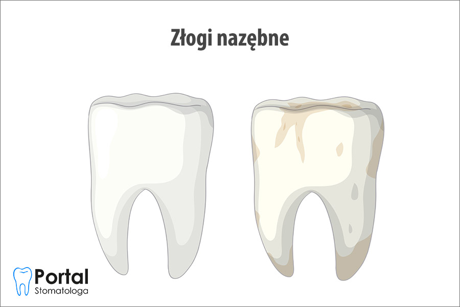 Złogi nazębne