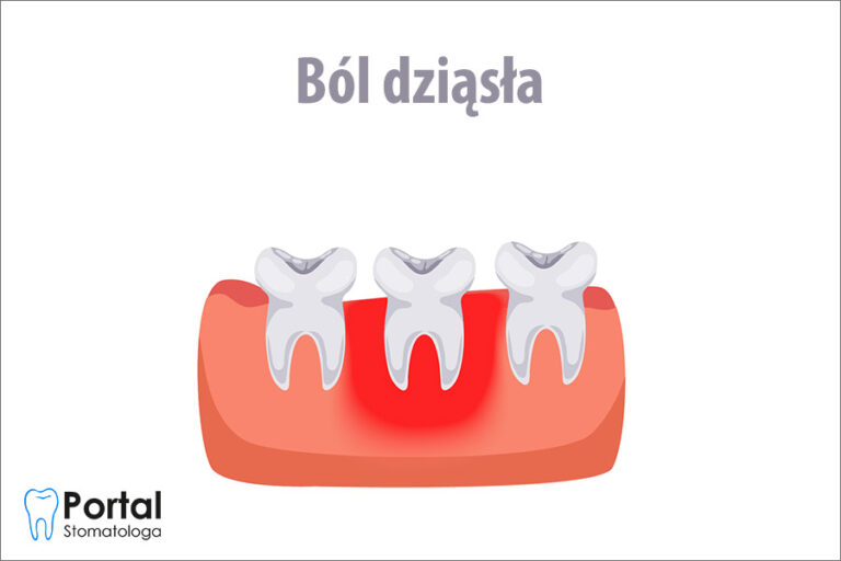 Ból dziąsła
