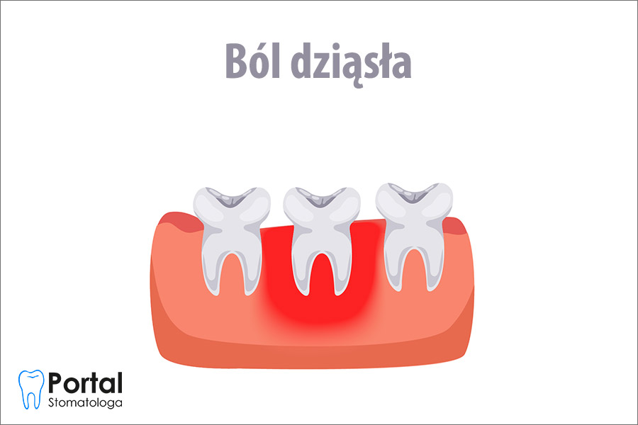 Ból dziąsła
