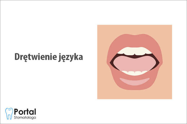 Drętwienie języka