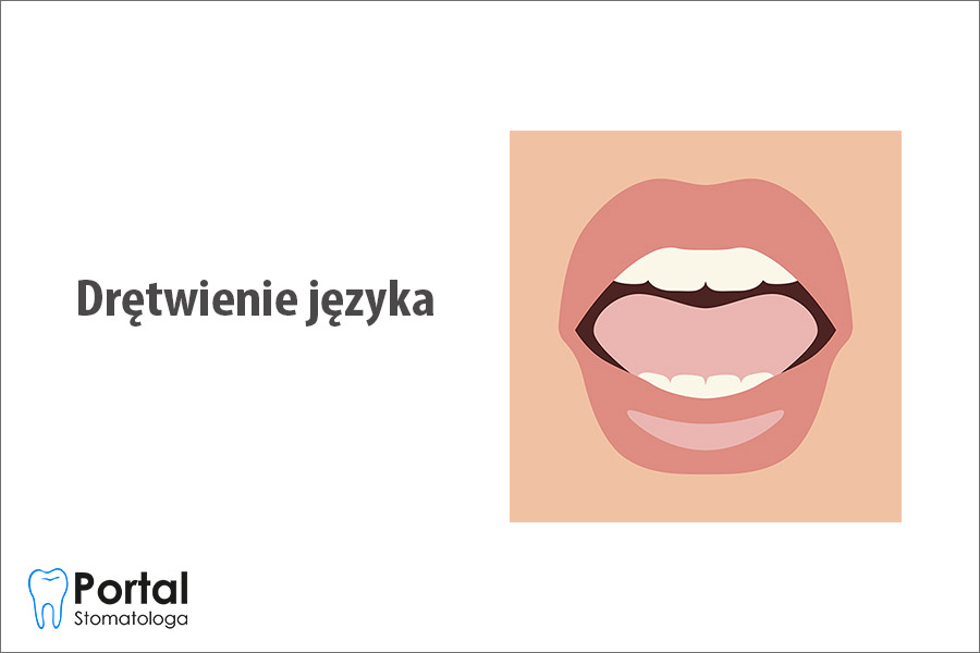 Drętwienie języka