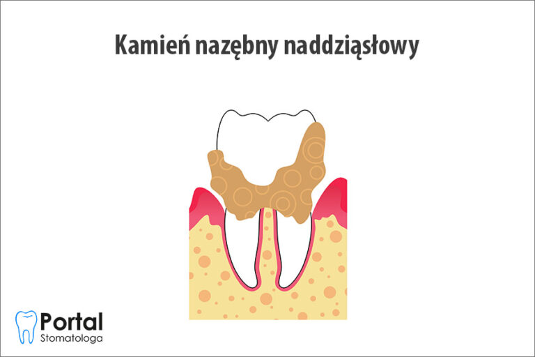 Kamień nazębny naddziąsłowy