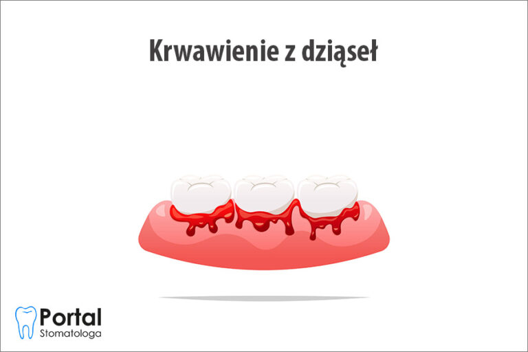 Krwawienie z dziąseł