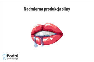 Nadmierna produkcja śliny