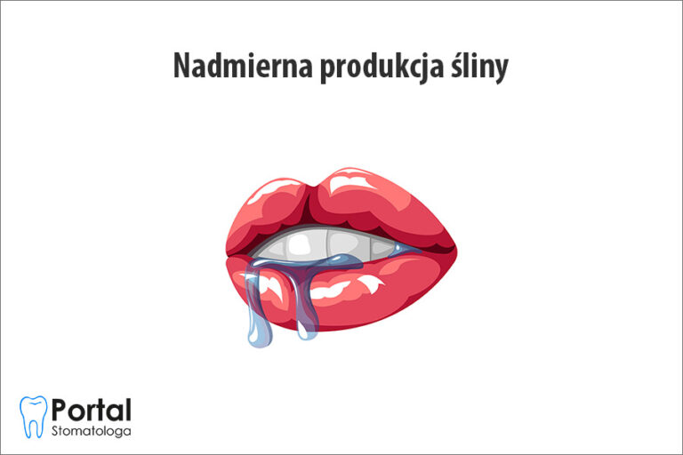 Nadmierna produkcja śliny