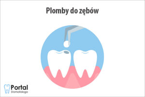 Plomby do zębów