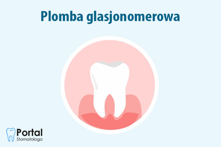 Plomba glasjonomerowa