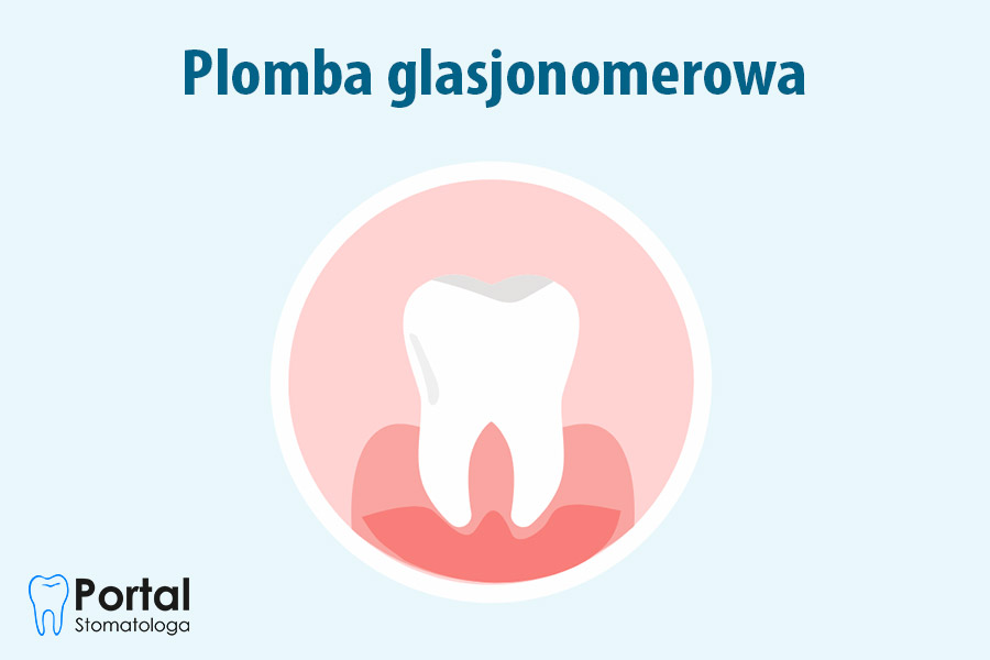 Plomba glasjonomerowa
