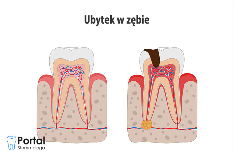 Ubytek w zębie
