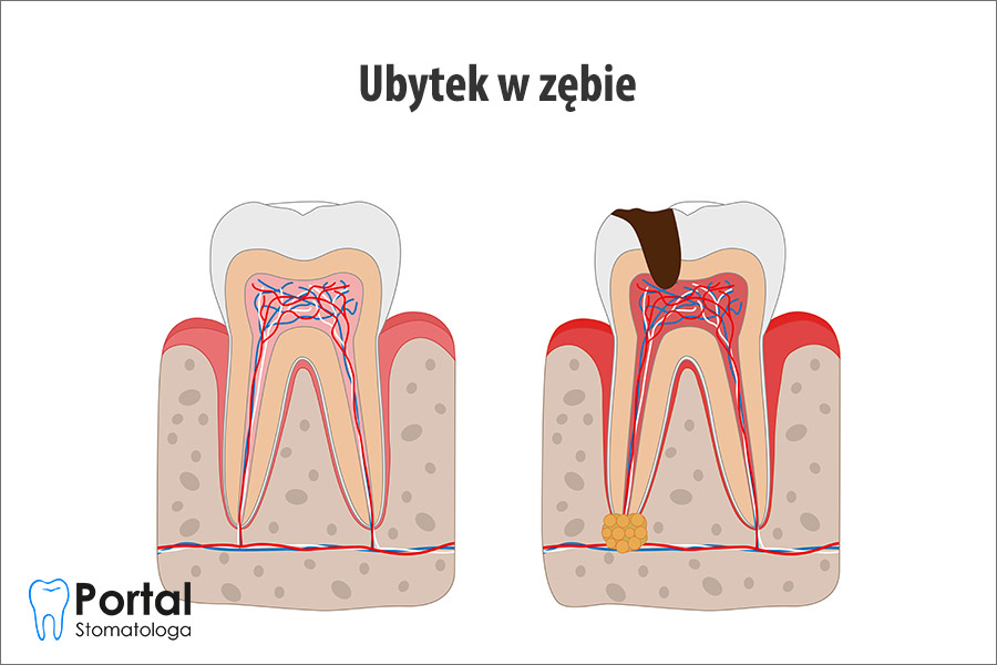 Ubytek w zębie