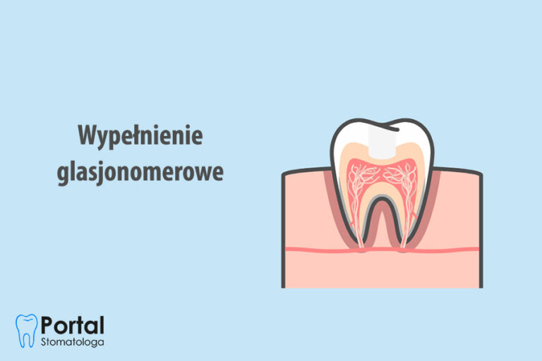 Wypełnienie glasjonomerowe