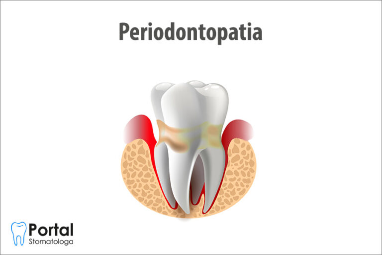 Periodontopatia