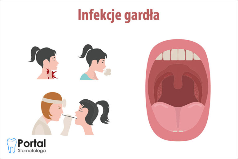 Infekcje gardła