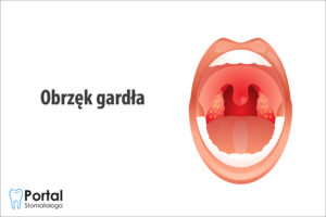 Obrzęk gardła