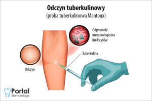 Odczyn tuberkulinowy