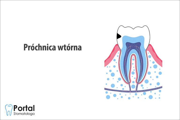 Próchnica wtórna