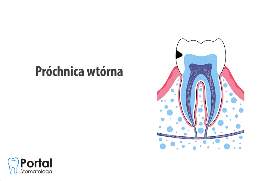 Próchnica wtórna