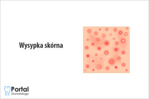 Wysypka skórna