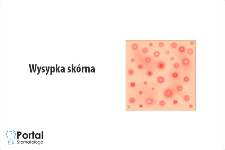 Wysypka skórna