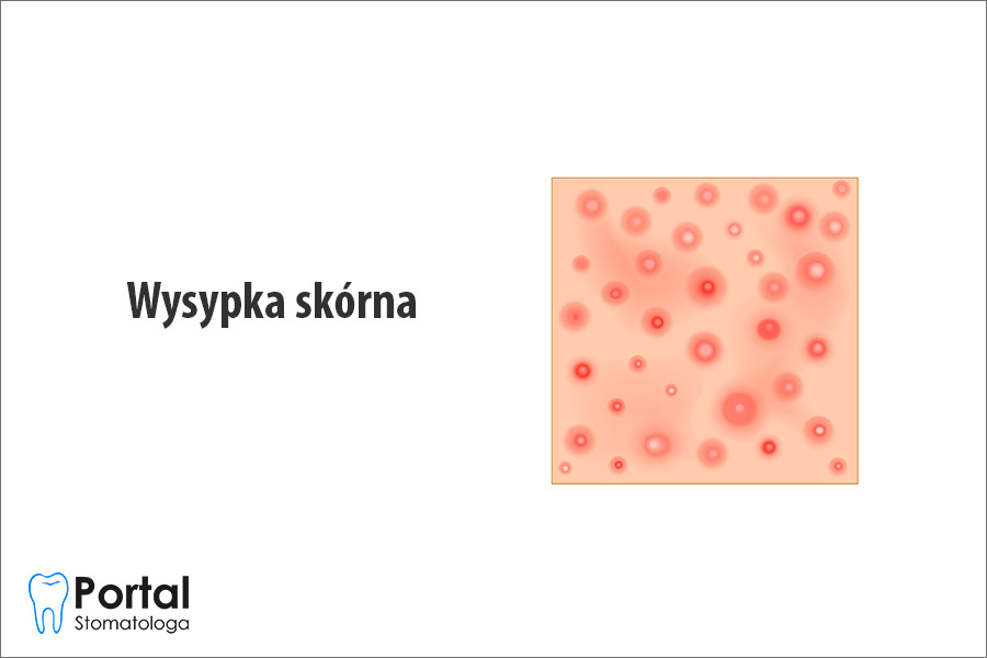 Wysypka skórna