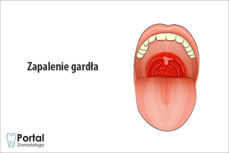 Zapalenie gardła