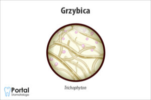 Grzybica