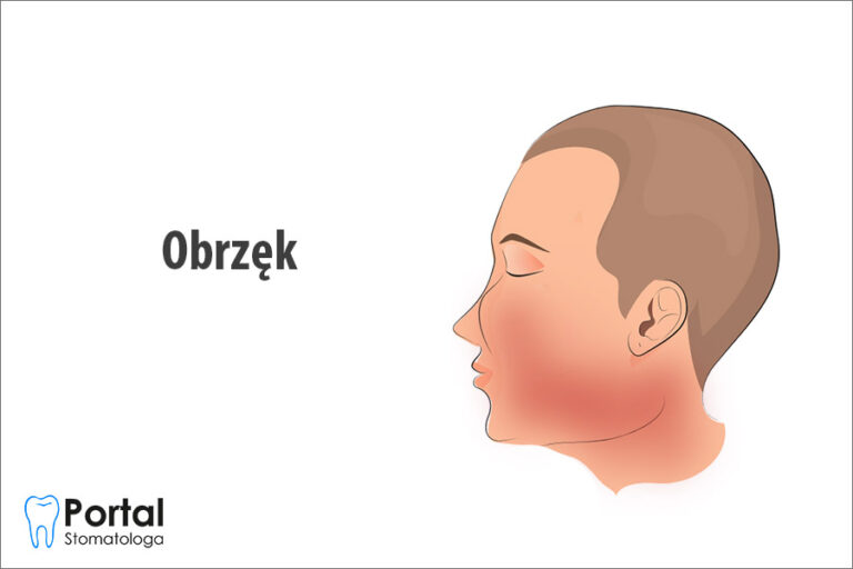 Obrzęk