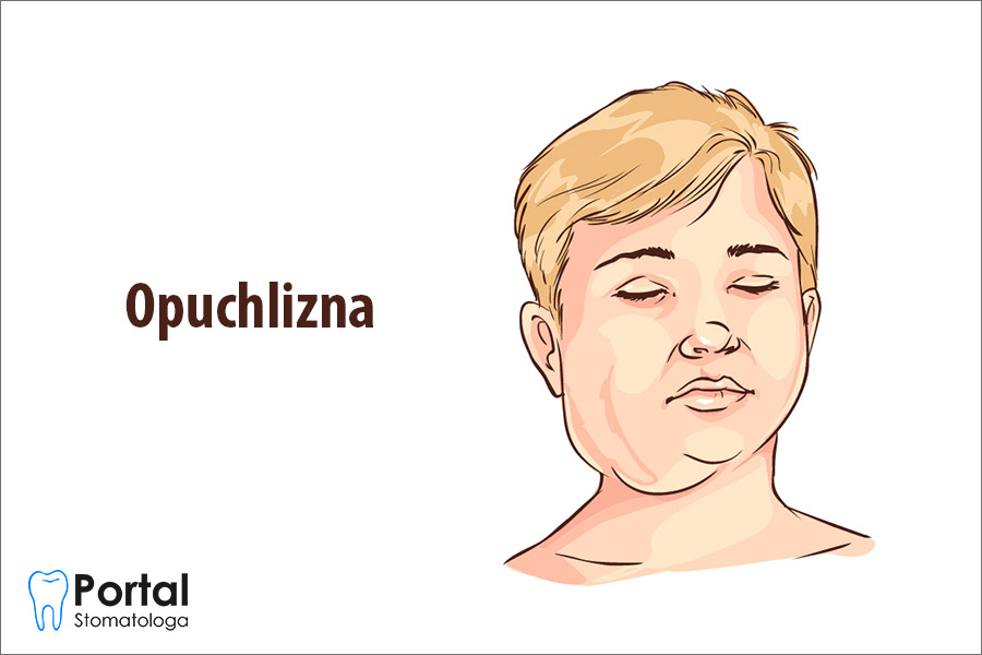 Opuchlizna