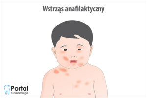 Wstrząs anafilaktyczny