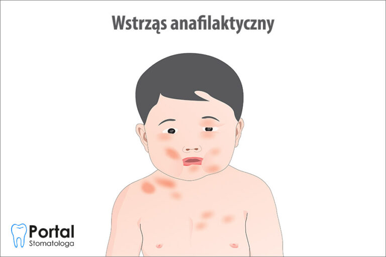 Wstrząs anafilaktyczny