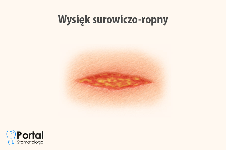 Wysięk surowiczo-ropny