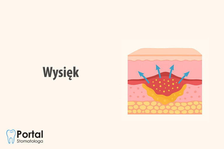 Wysięk