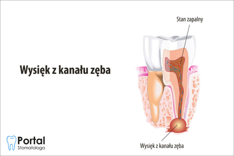 Wysięk z kanału zęba