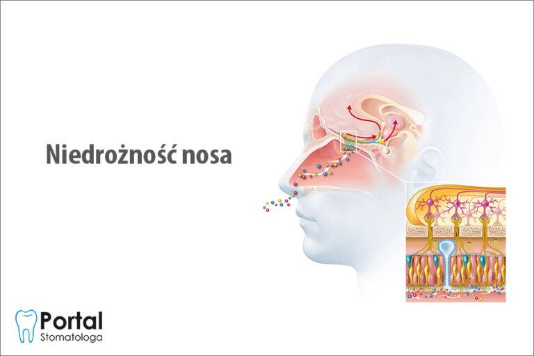 Niedrożność nosa