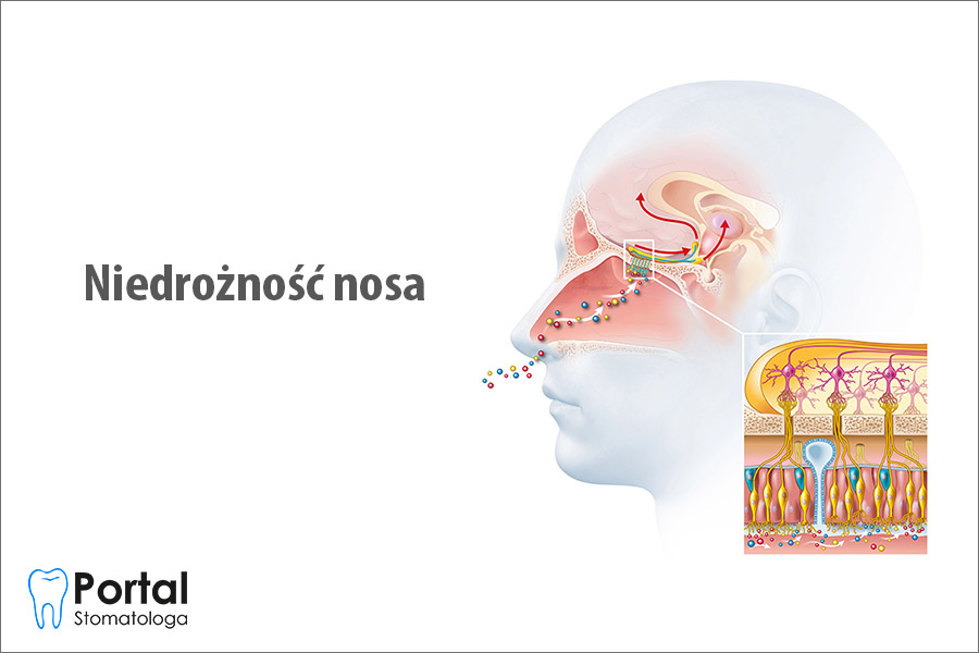 Niedrożność nosa