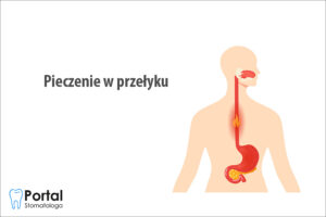 Pieczenie w przełyku