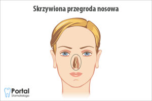 Skrzywiona przegroda nosowa