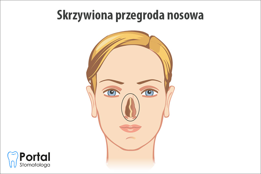 Skrzywiona przegroda nosowa
