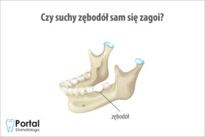 Czy suchy zębodół sam się zagoi?