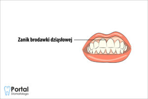 Zanik brodawki dziąsłowej
