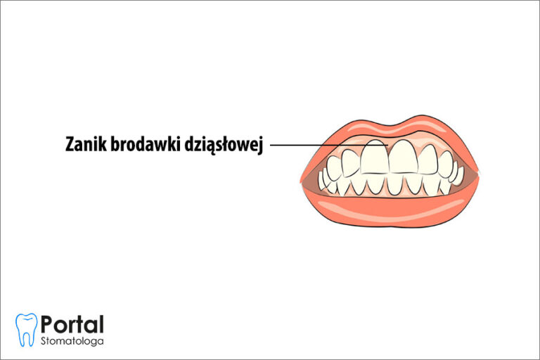 Zanik brodawki dziąsłowej