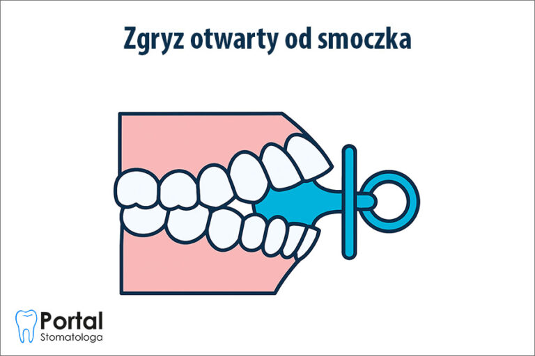 Zgryz otwarty od smoczka