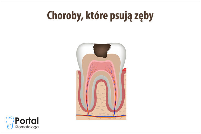 Choroby, które psują zęby