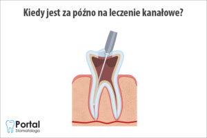 Kiedy jest za późno na leczenie kanałowe?