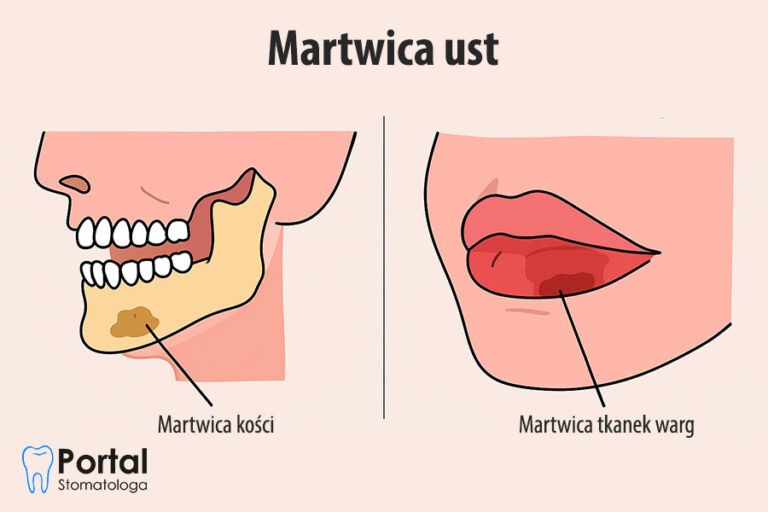 Martwica ust