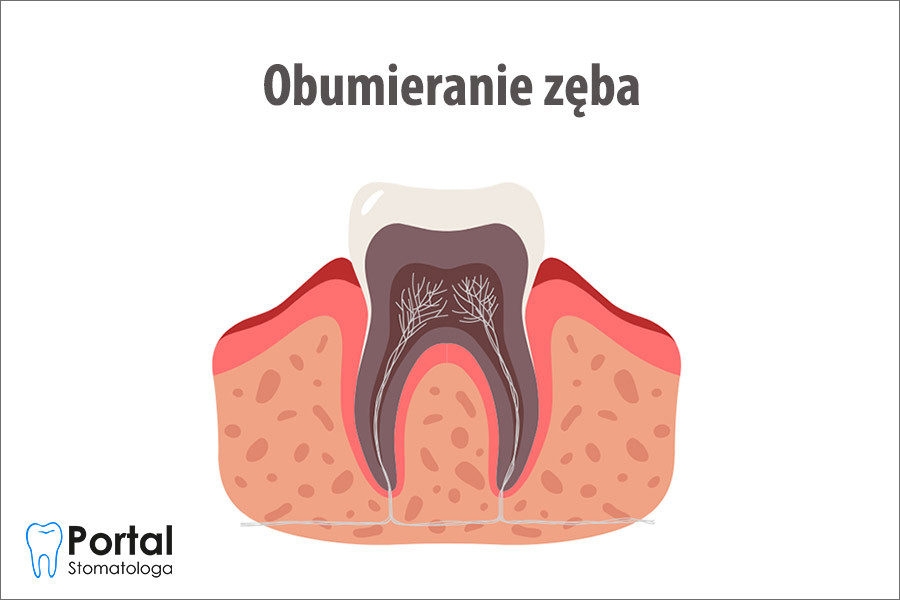Obumieranie zęba