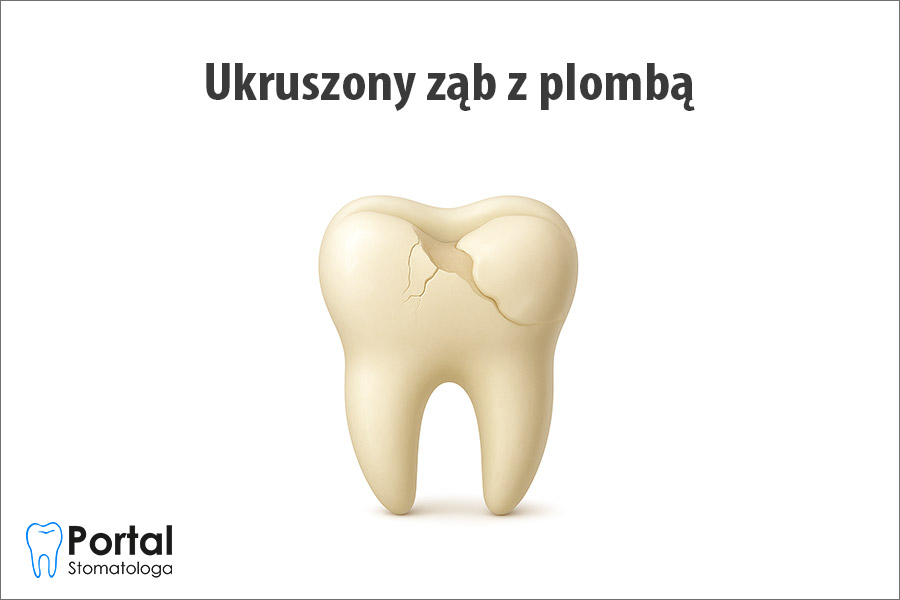 Ukruszony ząb z plombą